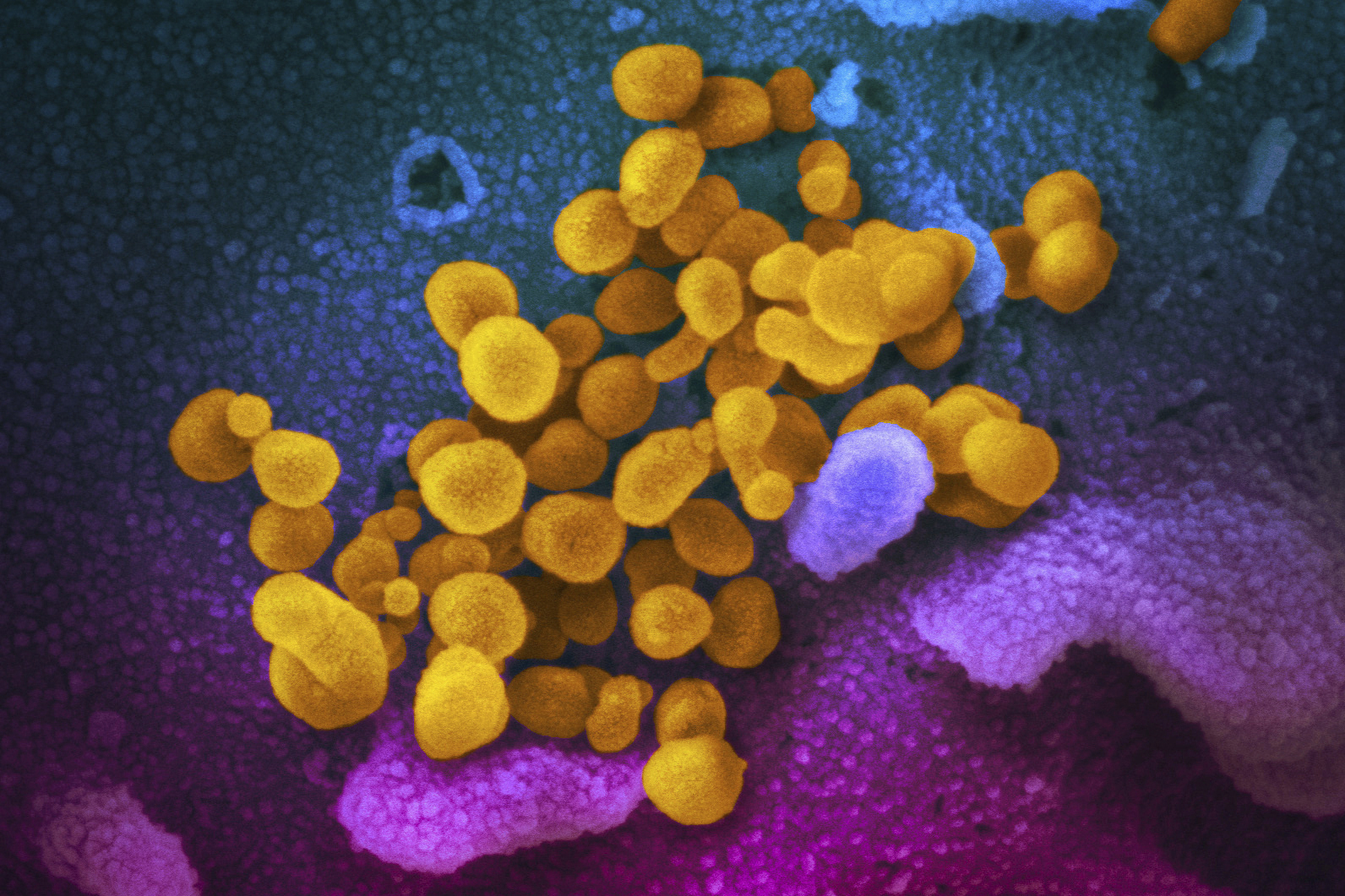 FILE - This undated, colorized electron microscope image made available by the U.S. National Institutes of Health in February 2020 shows the Novel Coronavirus SARS-CoV-2, indicated in yellow, emerging from the surface of cells, indicated in blue/pink, cultured in a laboratory. The sample was isolated from a patient in the U.S. There’s less risk of getting long COVID in the omicron era than in the pandemic’s earlier waves, according to a study of nearly 10,000 Americans that aims to help scientists better understand the mysterious condition, published in JAMA on Thursday, May 25, 2023. (NIAID-RML via AP, File)